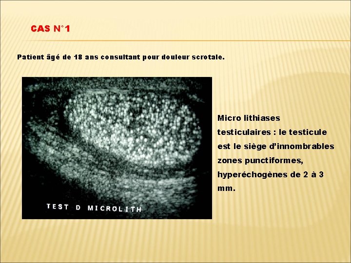 CAS N° 1 Patient âgé de 18 ans consultant pour douleur scrotale. Micro lithiases