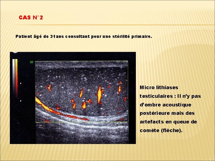 CAS N° 2 Patient âgé de 31 ans consultant pour une stérilité primaire. Micro