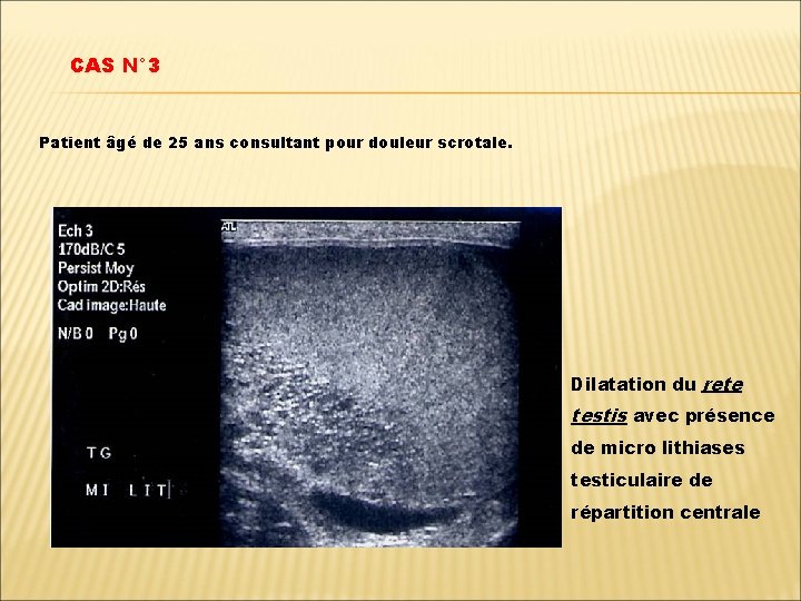 CAS N° 3 Patient âgé de 25 ans consultant pour douleur scrotale. Dilatation du