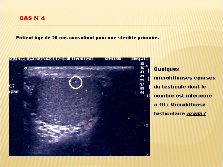 CAS N° 4 Patient âgé de 29 ans consultant pour une stérilité primaire. Quelques