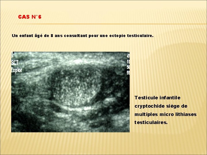 CAS N° 6 Un enfant âgé de 8 ans consultant pour une ectopie testiculaire.