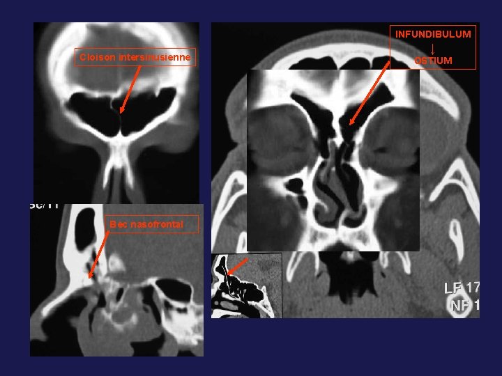 INFUNDIBULUM Cloison intersinusienne Bec nasofrontal ↓ OSTIUM 