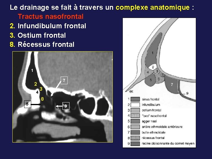 Le drainage se fait à travers un complexe anatomique : Tractus nasofrontal 2. Infundibulum