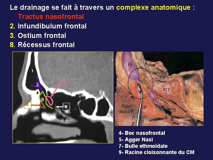 Le drainage se fait à travers un complexe anatomique : Tractus nasofrontal 2. Infundibulum