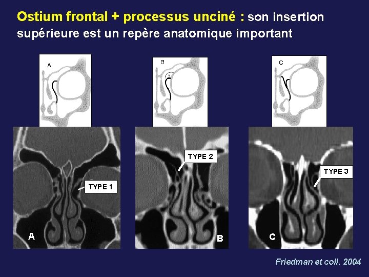 Ostium frontal + processus unciné : son insertion supérieure est un repère anatomique important