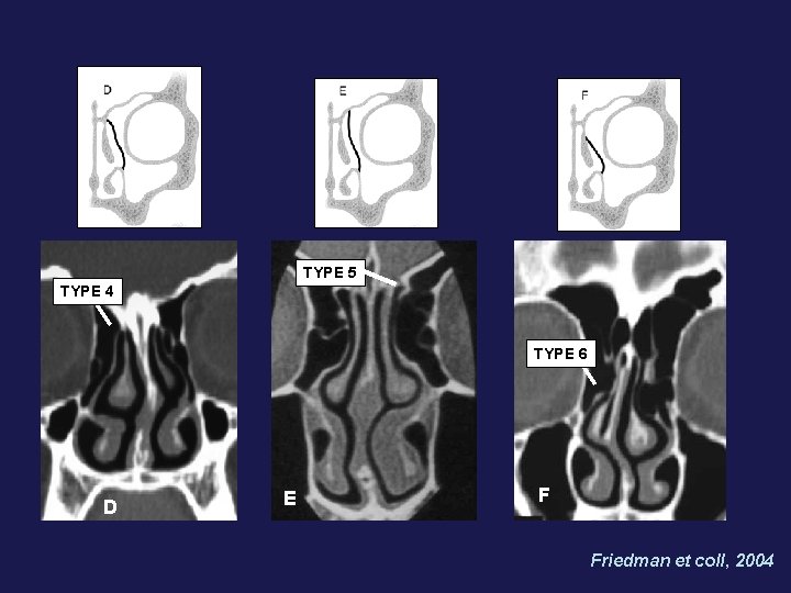 TYPE 5 TYPE 4 TYPE 6 D E F Friedman et coll, 2004 