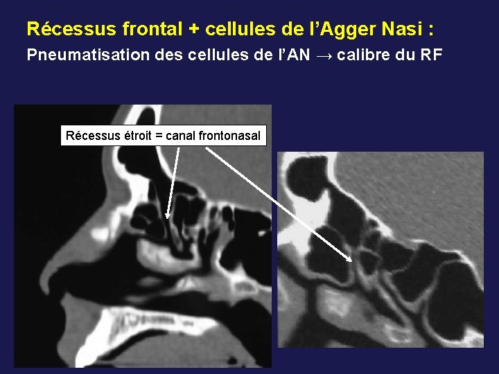 Récessus frontal + cellules de l’Agger Nasi : Pneumatisation des cellules de l’AN →