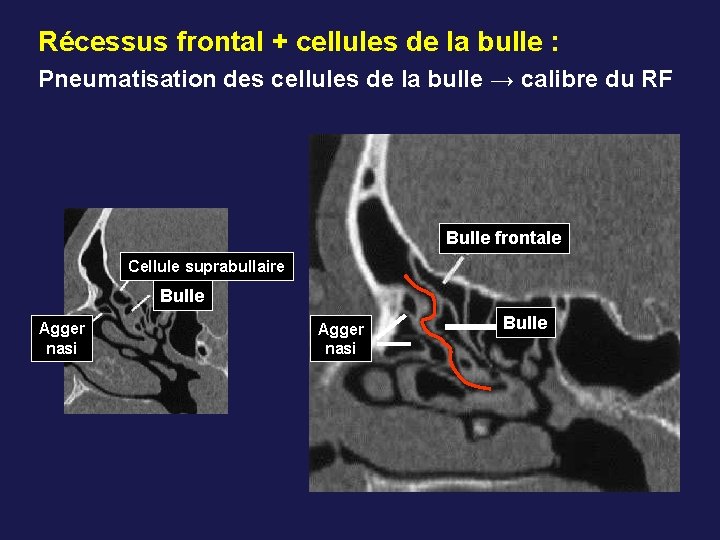 Récessus frontal + cellules de la bulle : Pneumatisation des cellules de la bulle