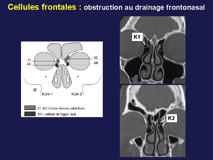 Cellules frontales : obstruction au drainage frontonasal K 1 K 2 