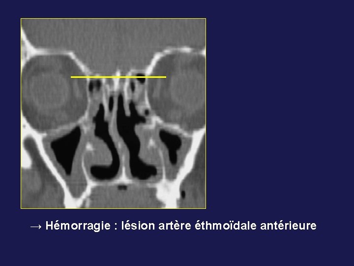 → Hémorragie : lésion artère éthmoïdale antérieure 