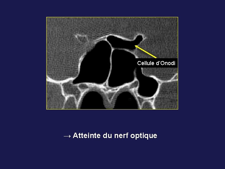 Cellule d’Onodi → Atteinte du nerf optique 