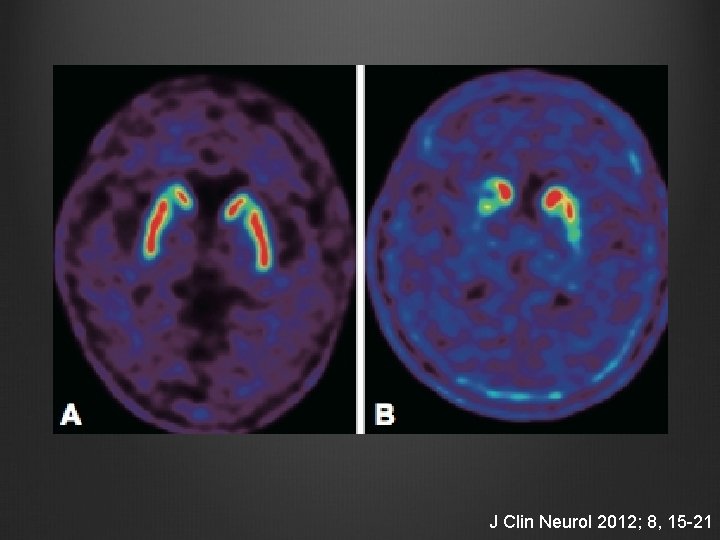 J Clin Neurol 2012; 8, 15 -21 