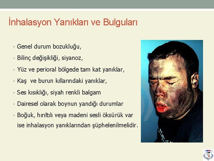 İnhalasyon Yanıkları ve Bulguları • Genel durum bozukluğu, • Bilinç değişikliği, siyanoz, • Yüz