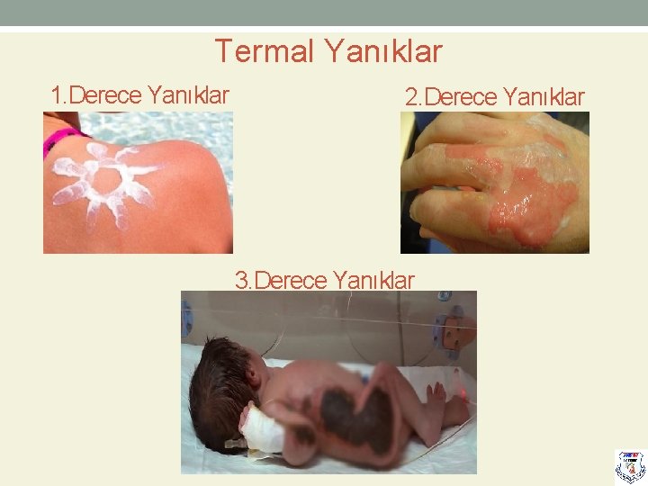 Termal Yanıklar 1. Derece Yanıklar 2. Derece Yanıklar 3. Derece Yanıklar 