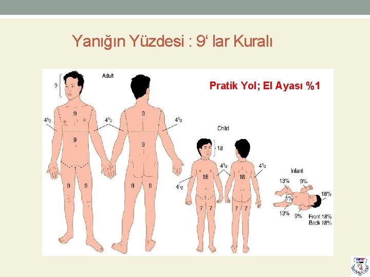 Yanığın Yüzdesi : 9‘ lar Kuralı Pratik Yol; El Ayası %1 