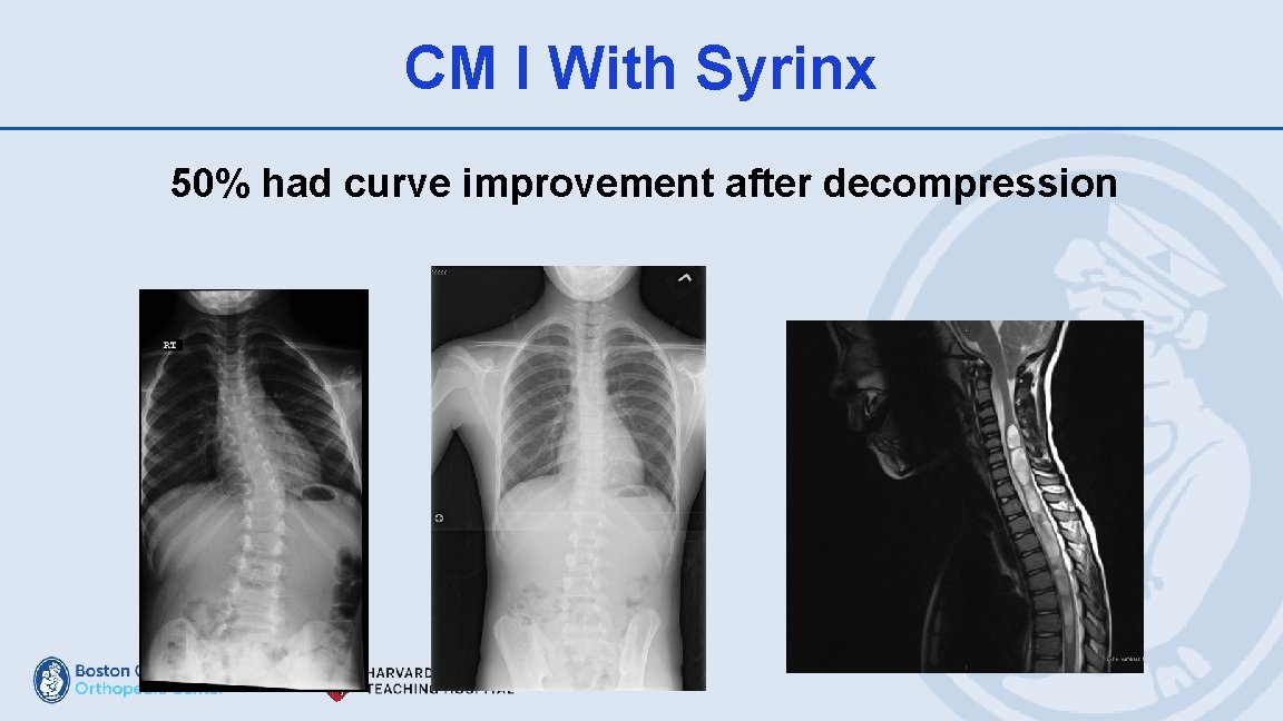 CM I With Syrinx 50% had curve improvement after decompression 