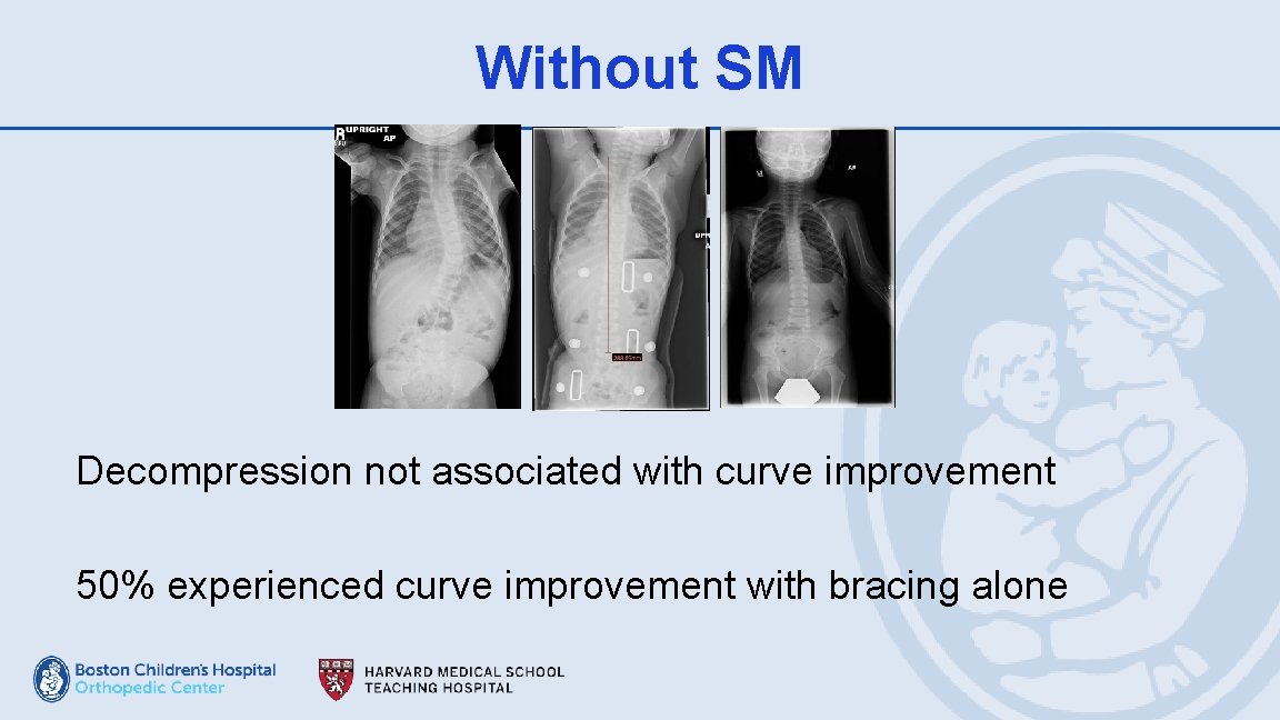 Without SM Decompression not associated with curve improvement 50% experienced curve improvement with bracing