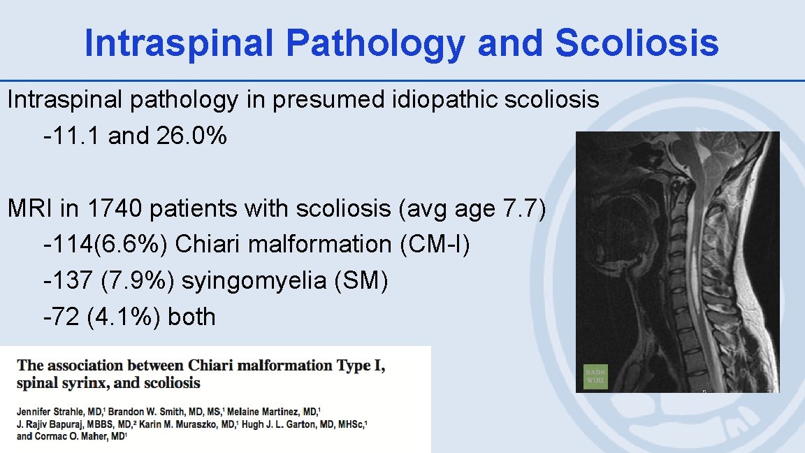 Intraspinal Pathology and Scoliosis Intraspinal pathology in presumed idiopathic scoliosis -11. 1 and 26.