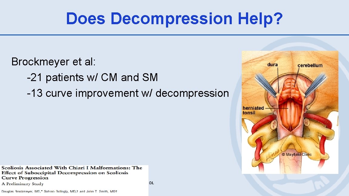 Does Decompression Help? Brockmeyer et al: -21 patients w/ CM and SM -13 curve