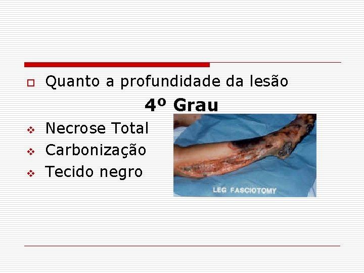 o Quanto a profundidade da lesão 4º Grau v v v Necrose Total Carbonização