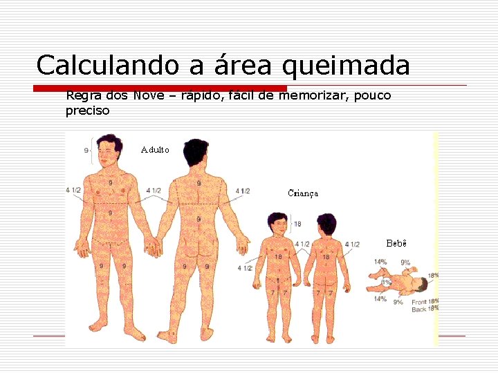 Calculando a área queimada Regra dos Nove – rápido, fácil de memorizar, pouco preciso