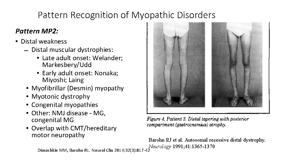 Pattern Recognition of Myopathic Disorders Pattern MP 2: • Distal weakness Distal muscular dystrophies: