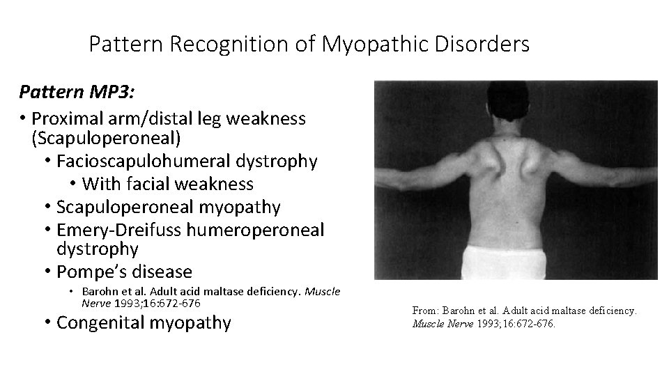 Pattern Recognition of Myopathic Disorders Pattern MP 3: • Proximal arm/distal leg weakness (Scapuloperoneal)