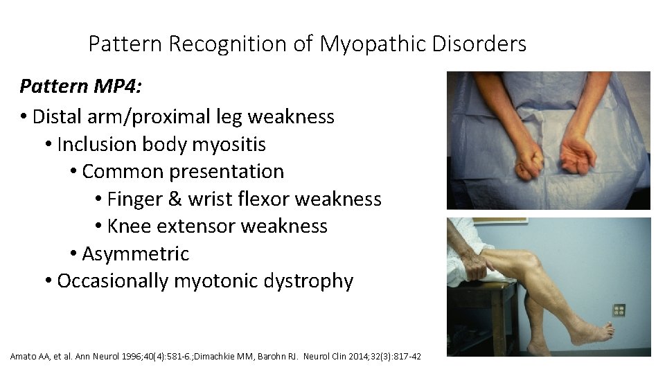 Pattern Recognition of Myopathic Disorders Pattern MP 4: • Distal arm/proximal leg weakness •