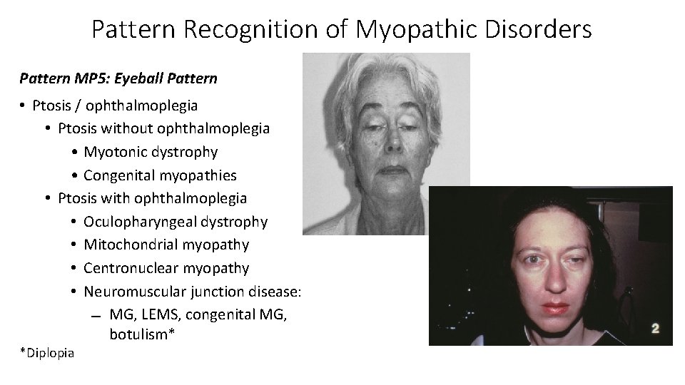 Pattern Recognition of Myopathic Disorders Pattern MP 5: Eyeball Pattern • Ptosis / ophthalmoplegia