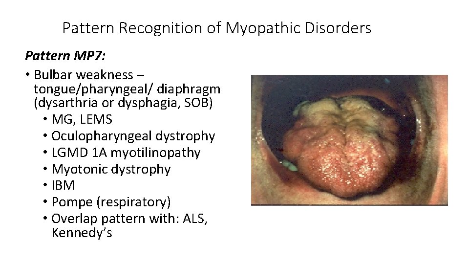 Pattern Recognition of Myopathic Disorders Pattern MP 7: • Bulbar weakness – tongue/pharyngeal/ diaphragm