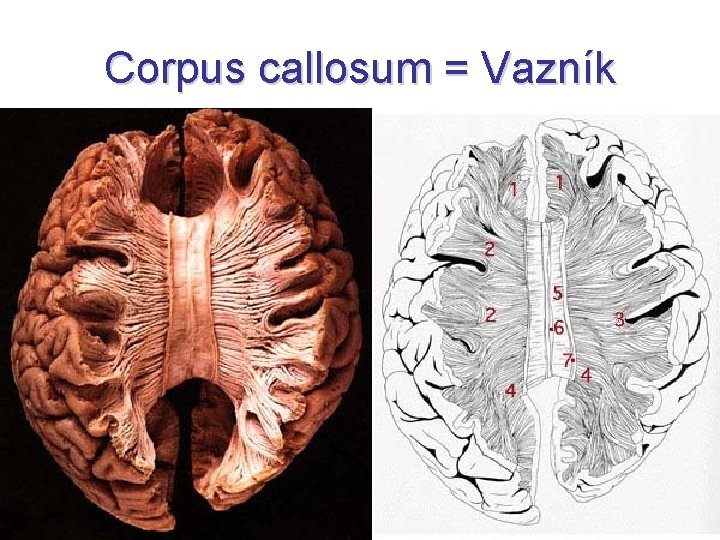 Corpus callosum = Vazník 