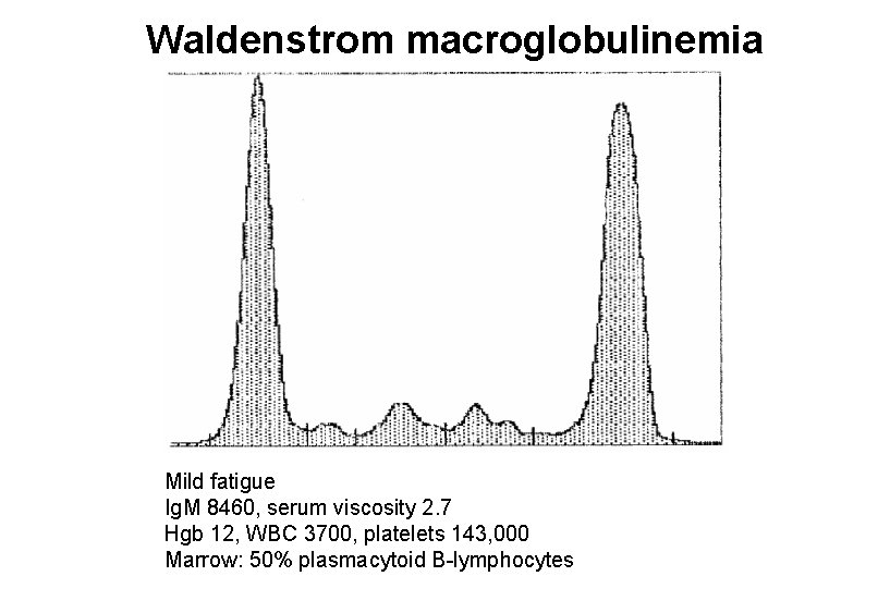 Waldenstrom macroglobulinemia Mild fatigue Ig. M 8460, serum viscosity 2. 7 Hgb 12, WBC Waldenstrom macroglobulinemia Mild fatigue Ig. M 8460, serum viscosity 2. 7 Hgb 12, WBC