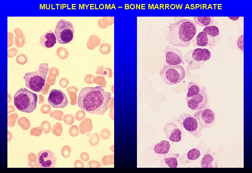 MULTIPLE MYELOMA – BONE MARROW ASPIRATE MULTIPLE MYELOMA – BONE MARROW ASPIRATE