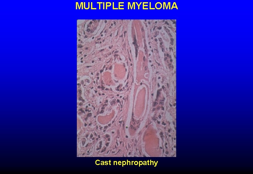 MULTIPLE MYELOMA Cast nephropathy 