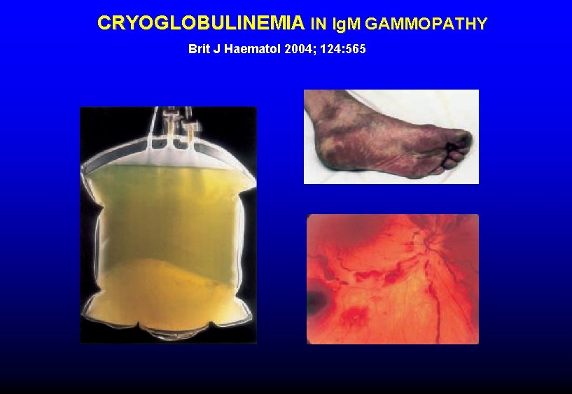 CRYOGLOBULINEMIA IN Ig. M GAMMOPATHY Brit J Haematol 2004; 124: 565 CRYOGLOBULINEMIA IN Ig. M GAMMOPATHY Brit J Haematol 2004; 124: 565