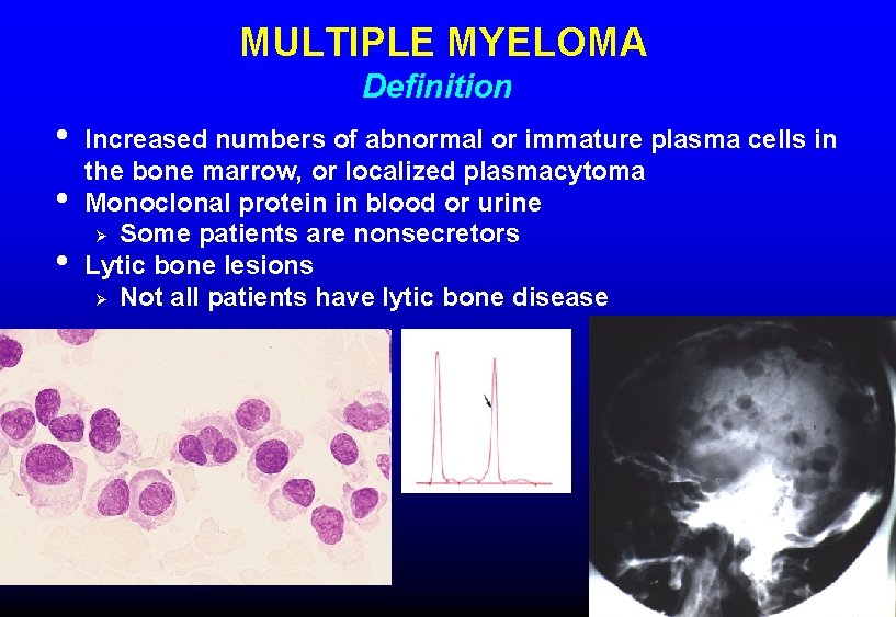 MULTIPLE MYELOMA Definition • • • Increased numbers of abnormal or immature plasma cells