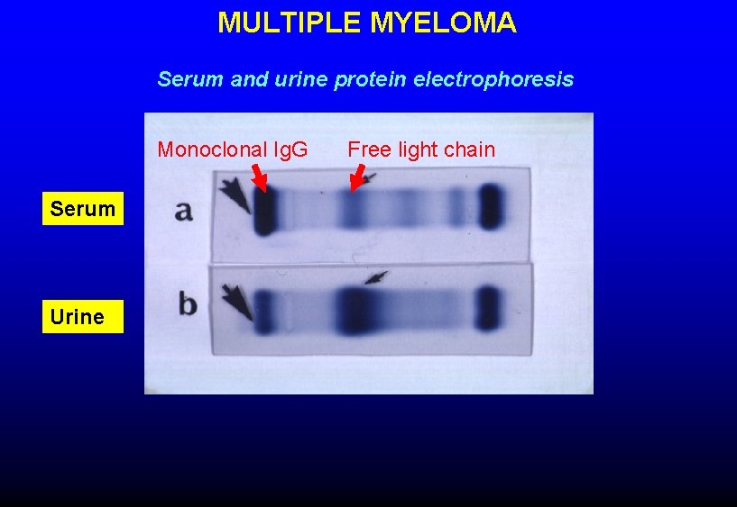 MULTIPLE MYELOMA Serum and urine protein electrophoresis Monoclonal Ig. G Serum Urine Free light