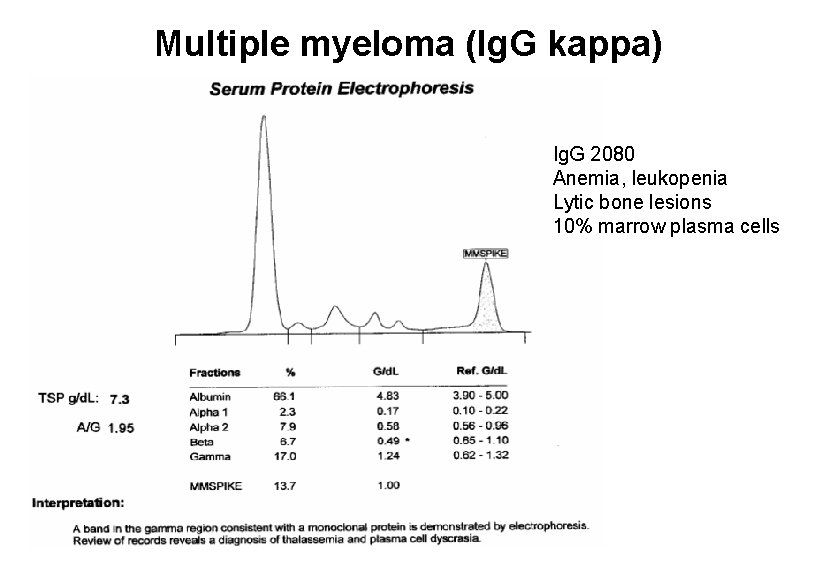 Multiple myeloma (Ig. G kappa) Ig. G 2080 Anemia, leukopenia Lytic bone lesions 10% Multiple myeloma (Ig. G kappa) Ig. G 2080 Anemia, leukopenia Lytic bone lesions 10%