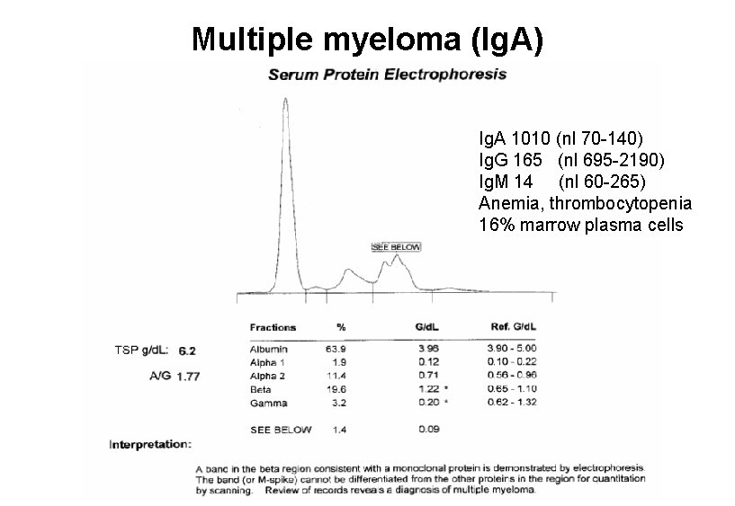 Multiple myeloma (Ig. A) Ig. A 1010 (nl 70 -140) Ig. G 165 (nl Multiple myeloma (Ig. A) Ig. A 1010 (nl 70 -140) Ig. G 165 (nl