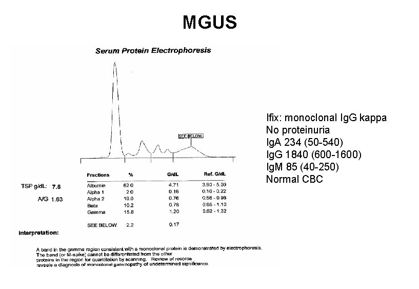 MGUS Ifix: monoclonal Ig. G kappa No proteinuria Ig. A 234 (50 -540) Ig. MGUS Ifix: monoclonal Ig. G kappa No proteinuria Ig. A 234 (50 -540) Ig.