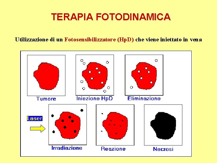 TERAPIA FOTODINAMICA Utilizzazione di un Fotosensibilizzatore (Hp. D) che viene iniettato in vena 