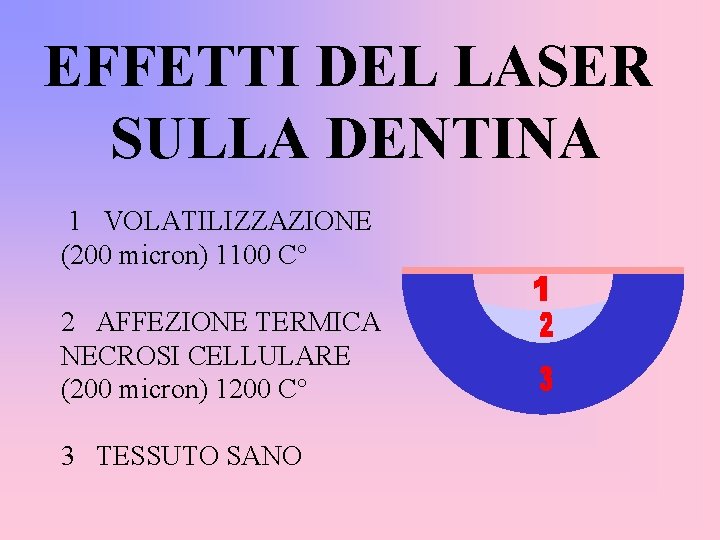 EFFETTI DEL LASER SULLA DENTINA 1 VOLATILIZZAZIONE (200 micron) 1100 C° 2 AFFEZIONE TERMICA