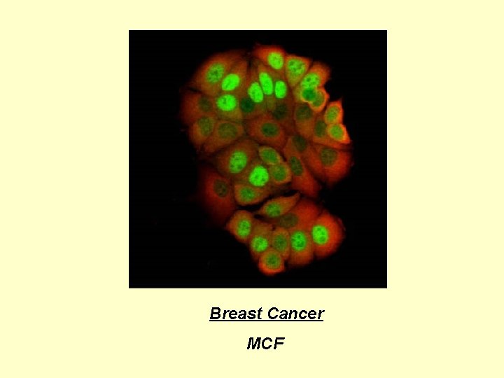 Breast Cancer MCF Breast Cancer MCF
