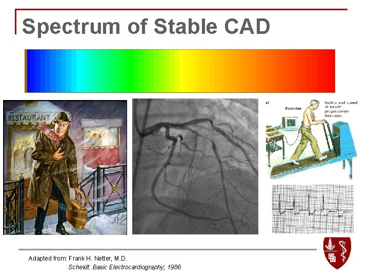 Spectrum of Stable CAD Adapted from: Frank H. Netter, M. D. Scheidt: Basic Electrocardiography;
