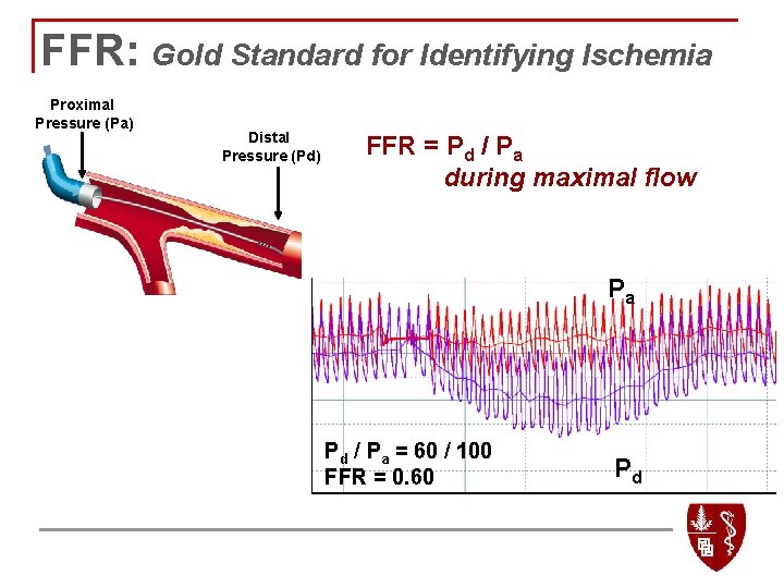 FFR: Gold Standard for Identifying Ischemia Proximal Pressure (Pa) Distal Pressure (Pd) FFR =