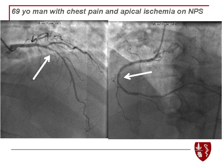 69 yo man with chest pain and apical ischemia on NPS 