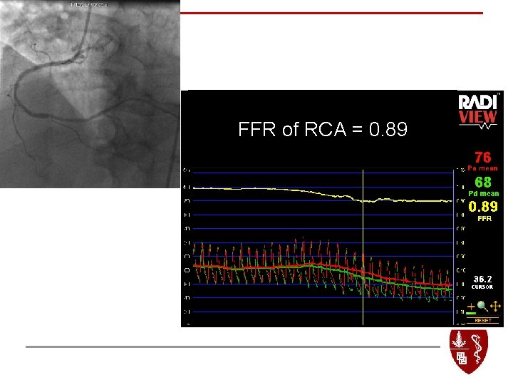 FFR of RCA = 0. 89 