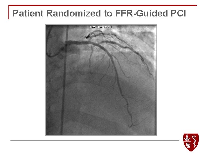 LAD after PCI Patient Randomized to FFR-Guided PCI 