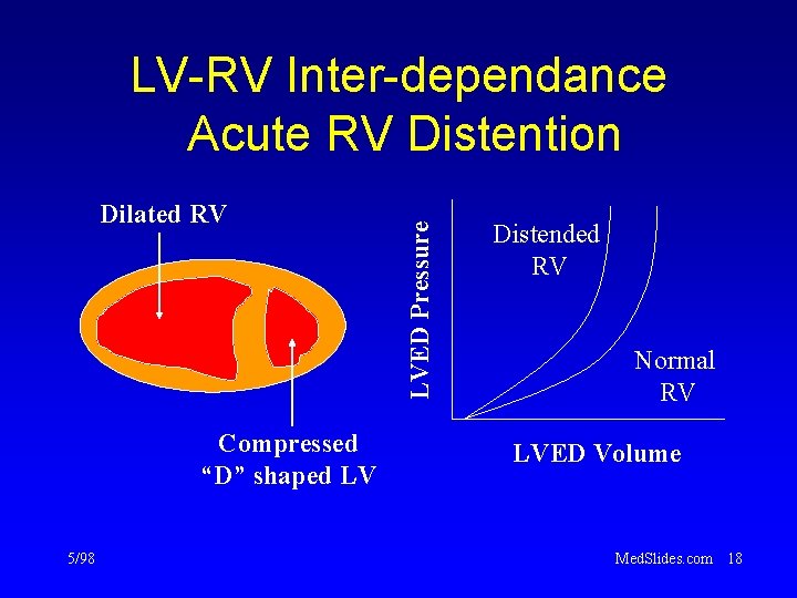 Dilated RV Compressed “D” shaped LV 5/98 LVED Pressure LV-RV Inter-dependance Acute RV Distention