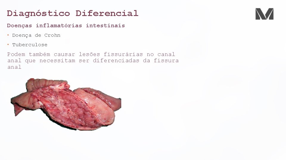 Diagnóstico Diferencial Doenças inflamatórias intestinais • Doença de Crohn • Tuberculose Podem também causar